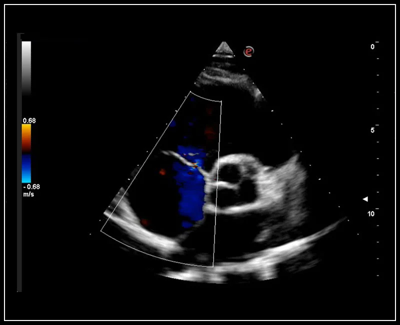 MyLab™Omega - Short axis big vessel right ventricle CFM