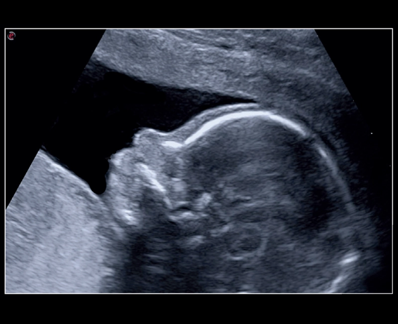 MyLab™X8 Platform - XView algorithm for increased visibility