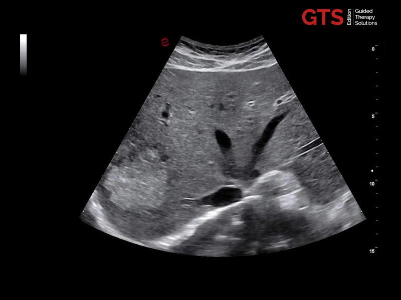B-Mode image of the liver