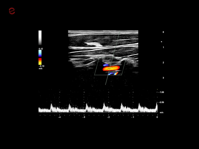 MyLab™C30 - Vertebral PW