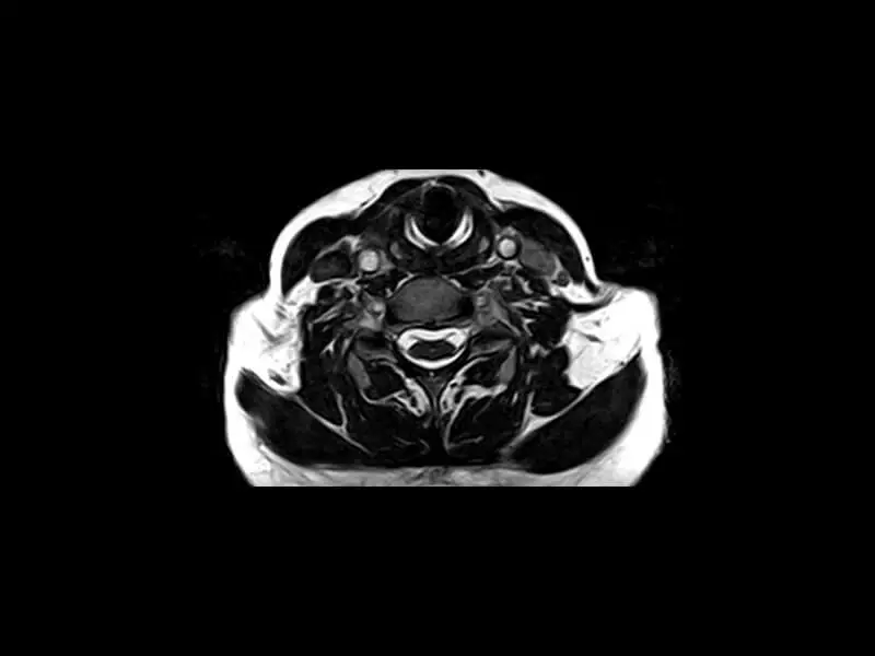 S-scan Open - Cervical 3D Hyce Axial