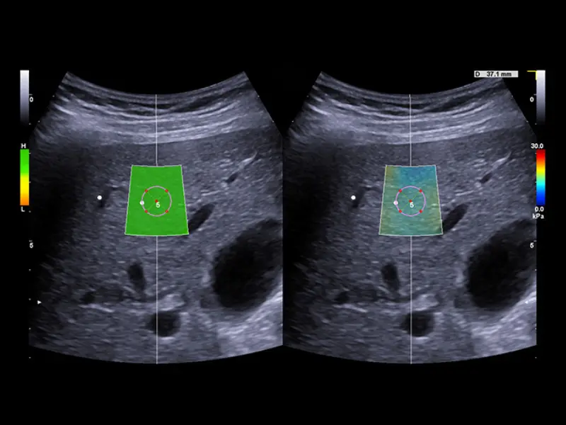 MyLab™X90 - Liver 03