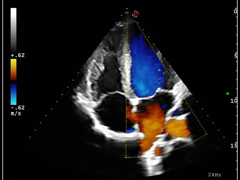 MyLab™9 Platform - Ultra-sensitivity Colour Doppler for precise visualization pulmonary veins
