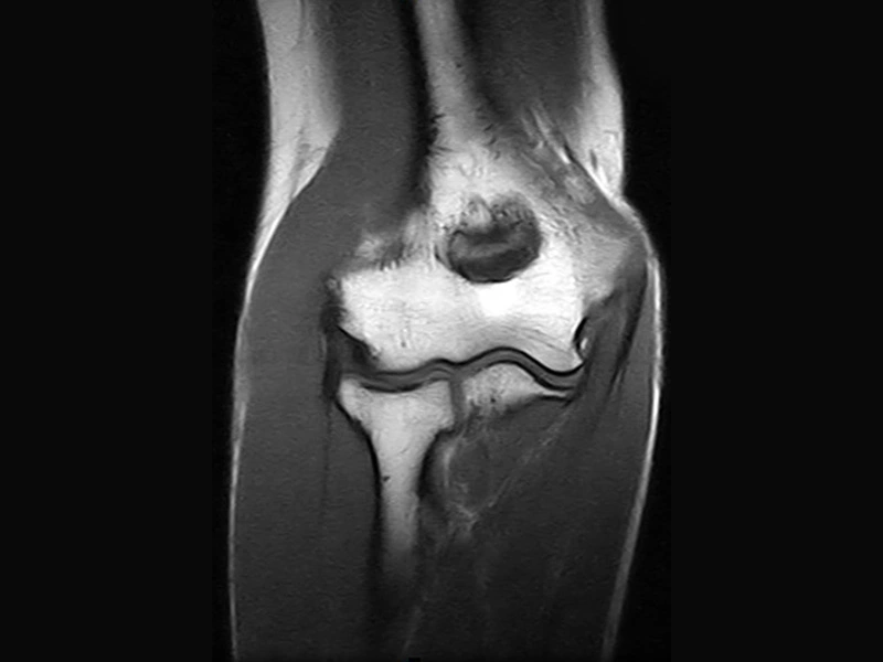 Magnifico™Open - Elbow SE T1 coronal