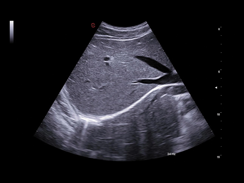 MyLab™A50 - Liver BMode