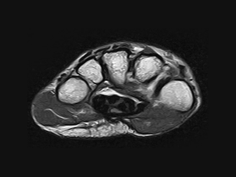 Magnifico™Open - Wrist FSE T2 axial