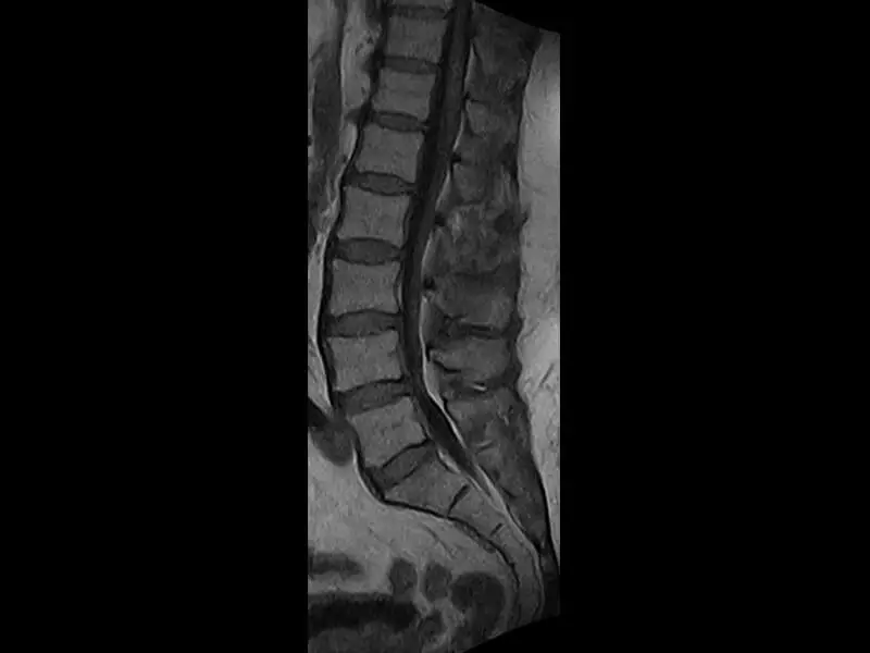 Magnifico™Open - Spine 2