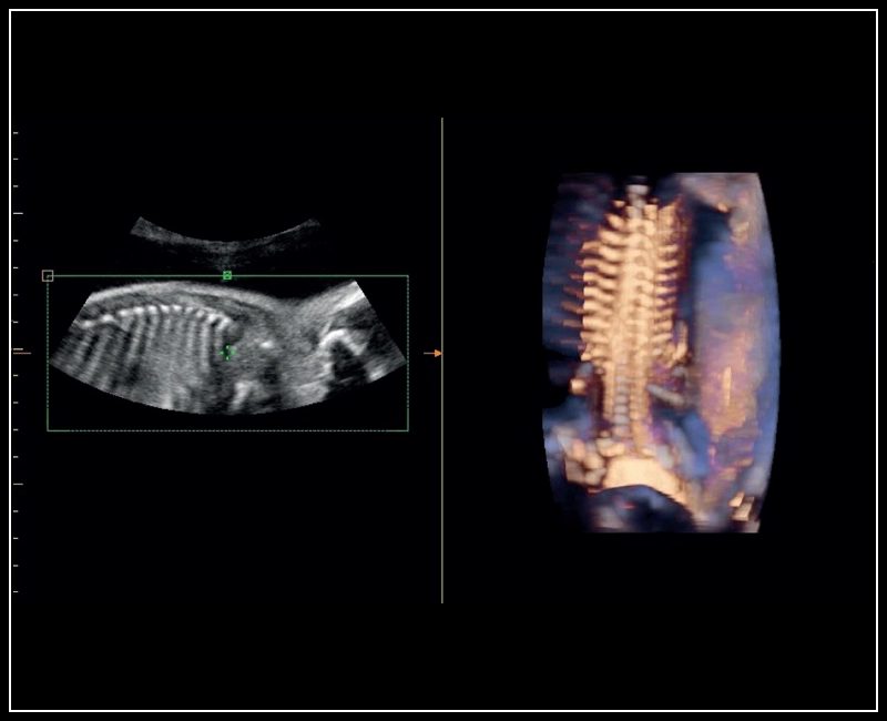 MyLab™Sigma - Semi transparent rendering of fetal spine