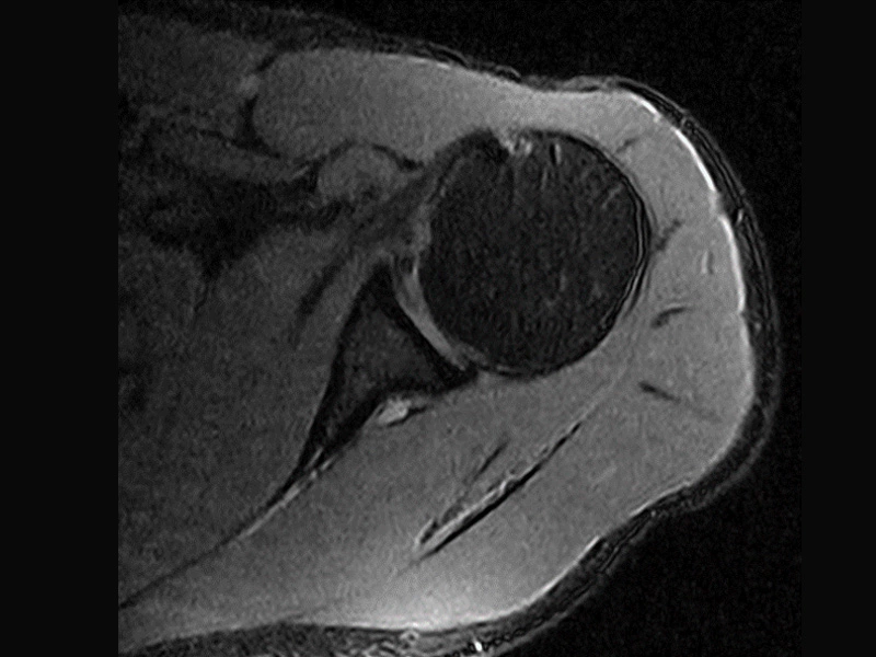 Magnifico™Open - Shoulder SPED axial