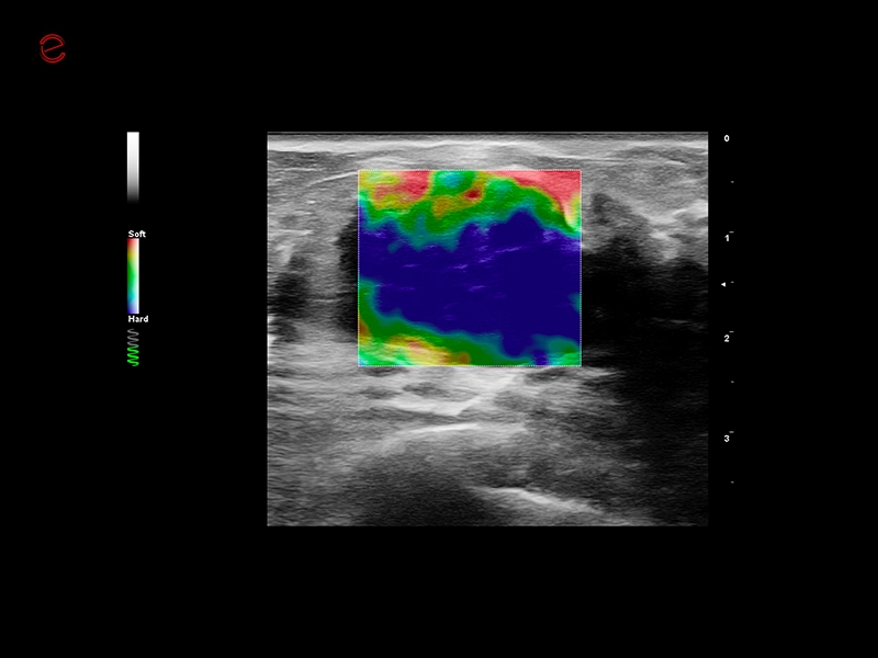 MyLab™C25 - ElaXto in breast