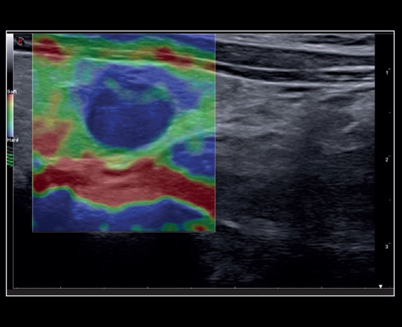 MyLab™X8 Platform - Lesion with ElaXto