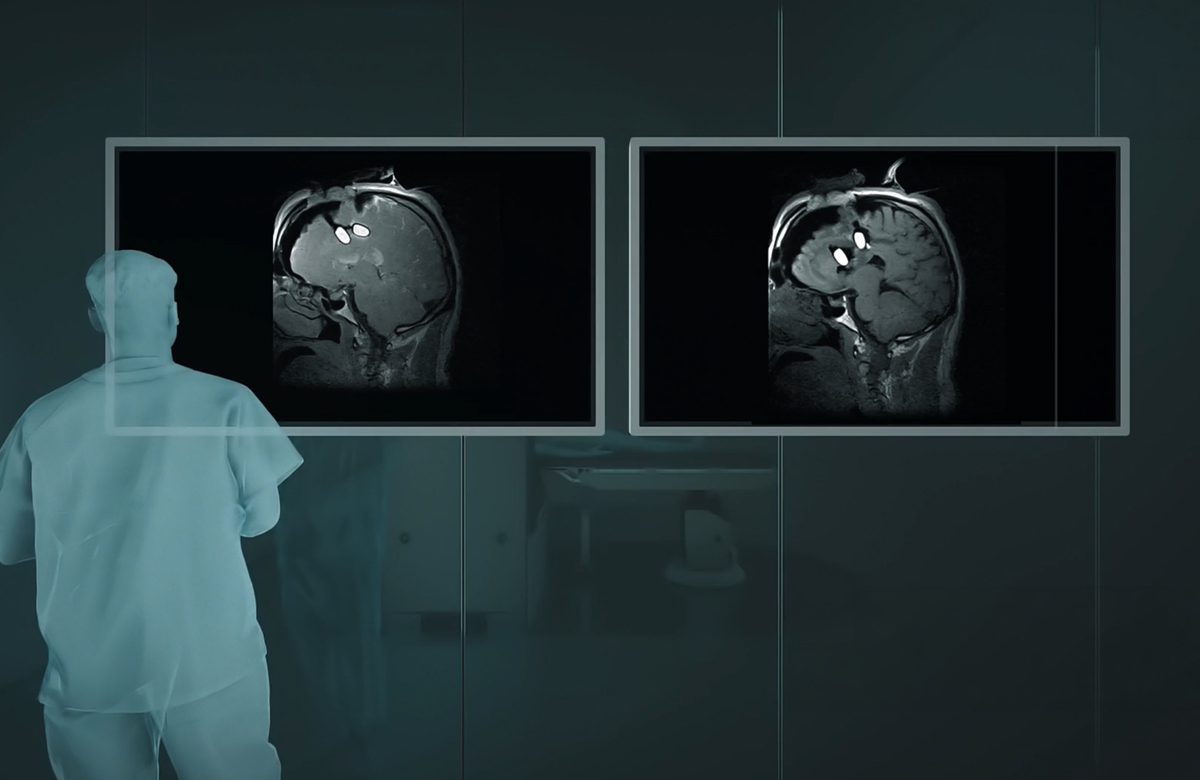 MRI directly inside the operating room