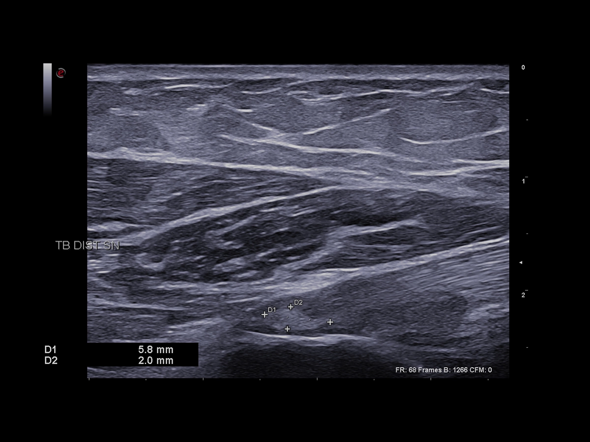 Toward excellence in very Superficial Imaging