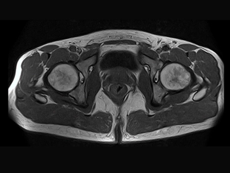 Magnifico™Open - Hip SE T1 axial