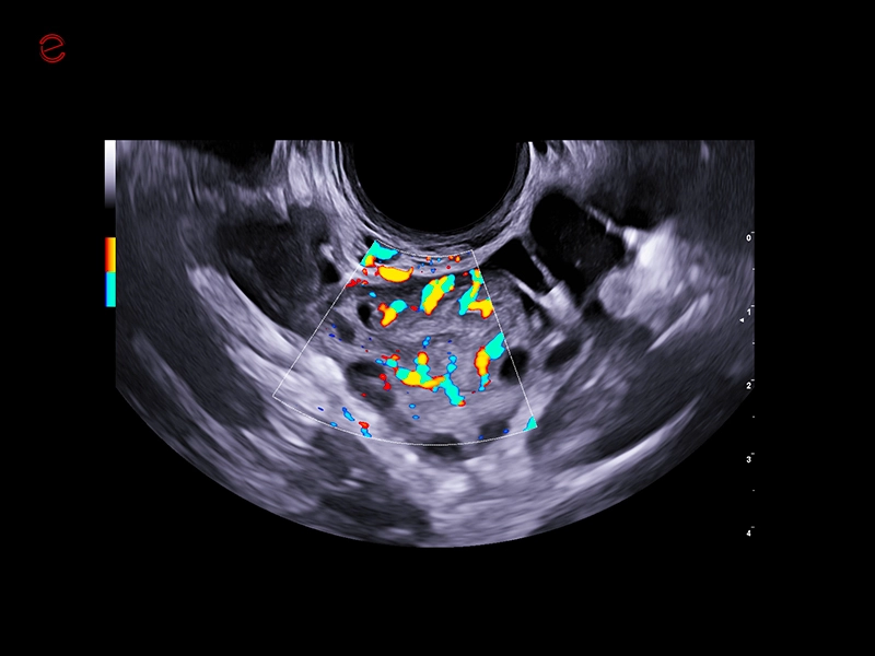 MyLab™C25 - Mioma PD