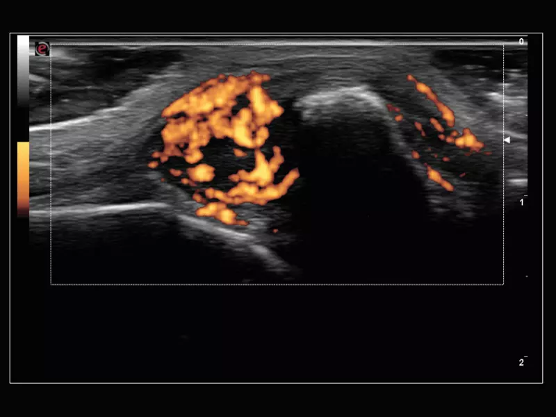 MyLab™Sigma Elite - Power Doppler on acute polyarthritis inflammation area with 18 MHz probe