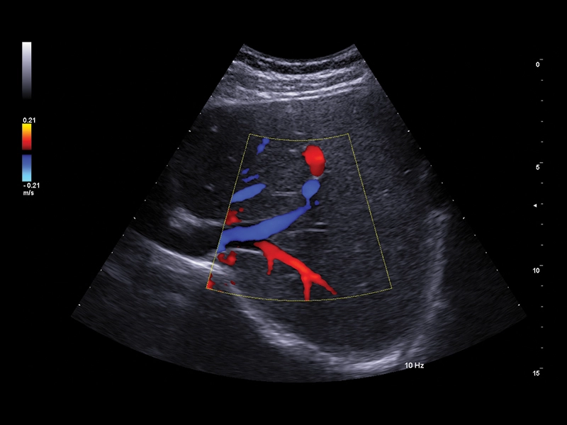 MyLab™A50 - CFM liver
