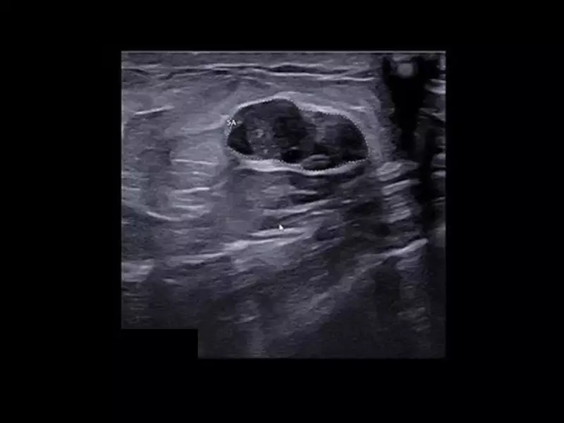 MyLab™X90 - BMA: Automatic proposal of breast lesion classification, inside a region of clinical interest (ROI)