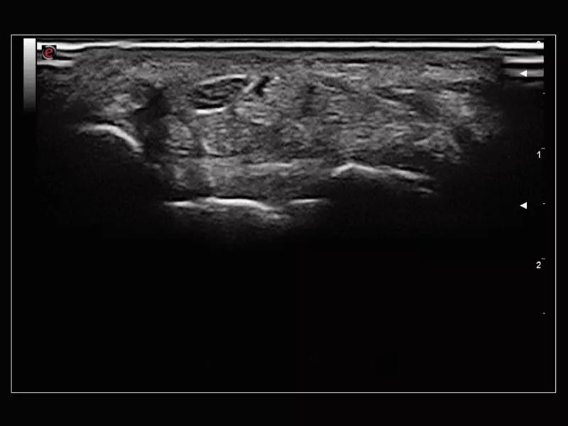 MyLab™Sigma Elite - B-Mode high resolution on median nerve