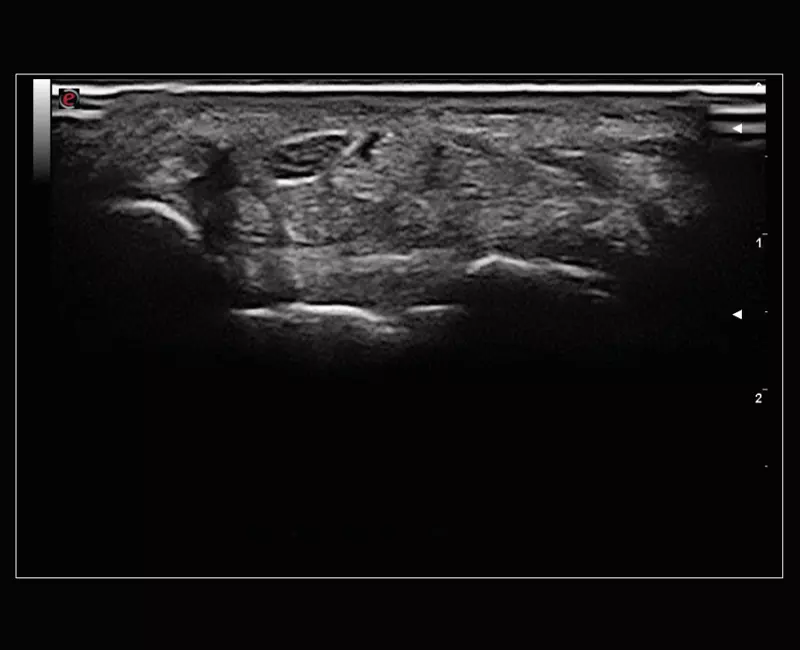 MyLab™Sigma Elite - B-Mode high resolution on median nerve