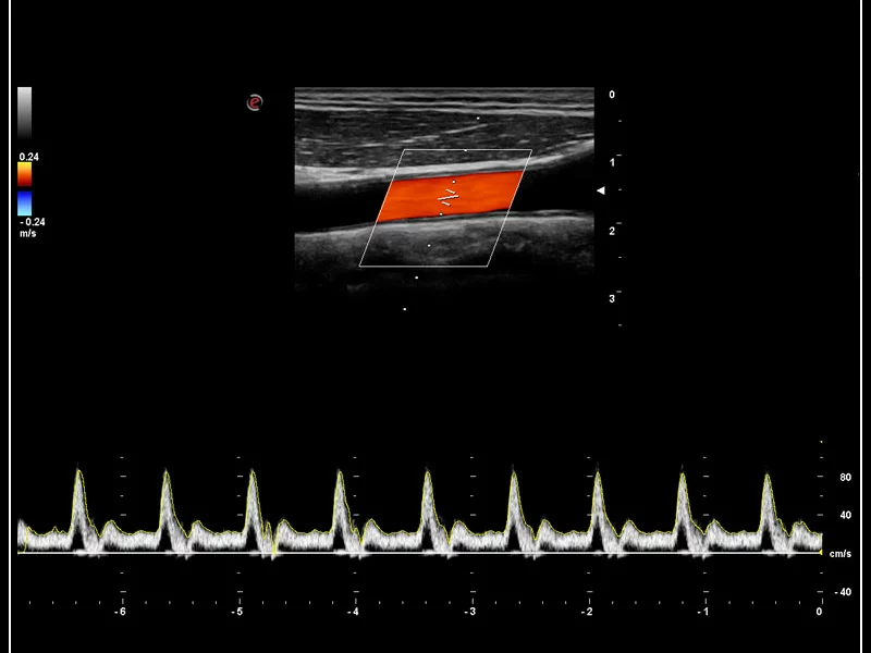 MyLab™9 Platform - PW Doppler with easyTrace optimization