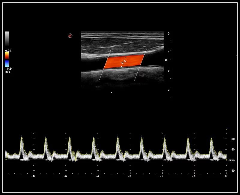 MyLab™9 Platform - PW Doppler with easyTrace optimization
