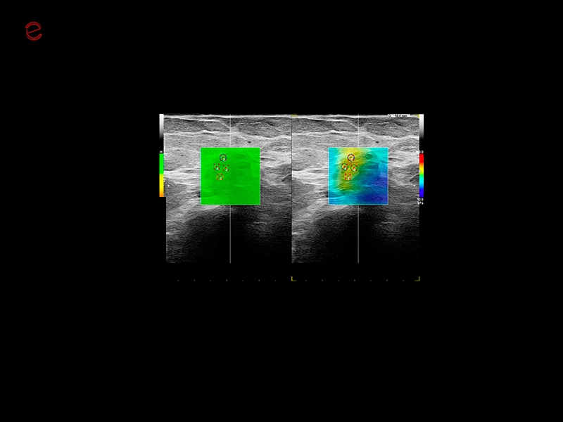 MyLab™C30 - SWE breast