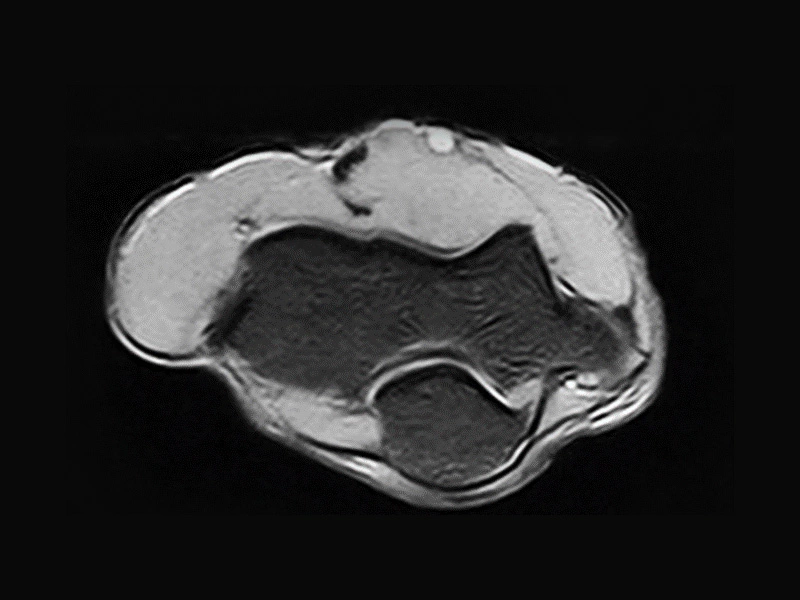 Magnifico™Open - Elbow SPED axial