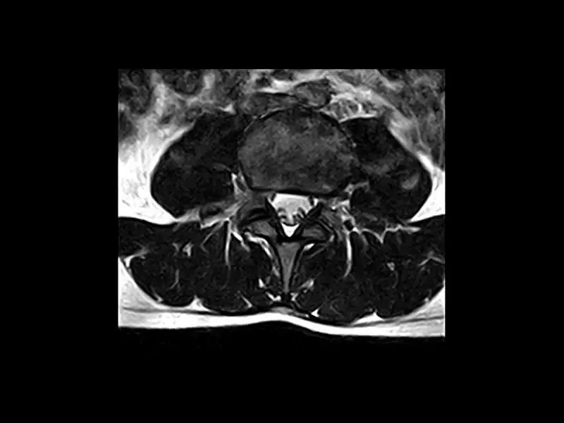 S-scan Open - 3D HYCE Lspine