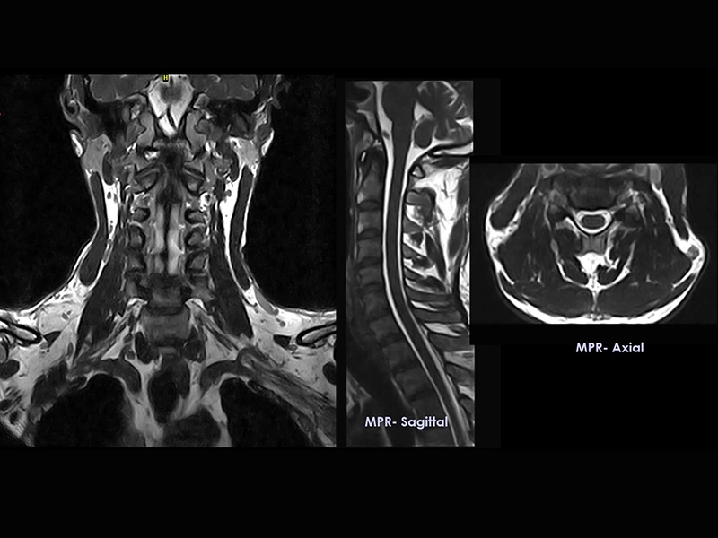 Magnifico™Open - Cspine-3DHyce