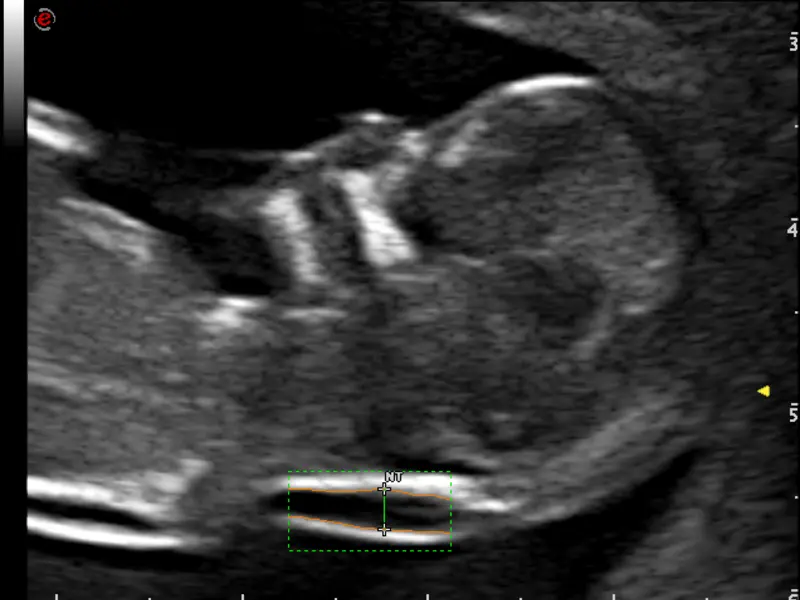 MyLab™ Omega - AutoNT