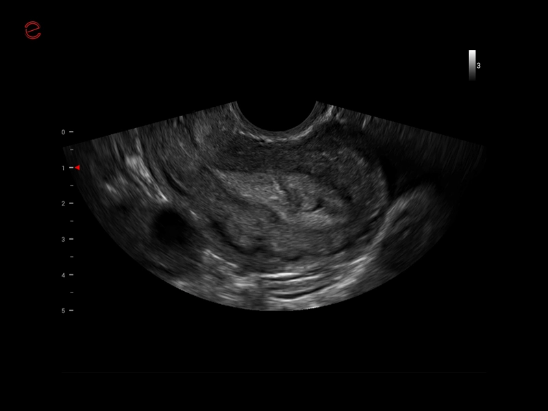 MyLab™X1 Go - WH Endometrium