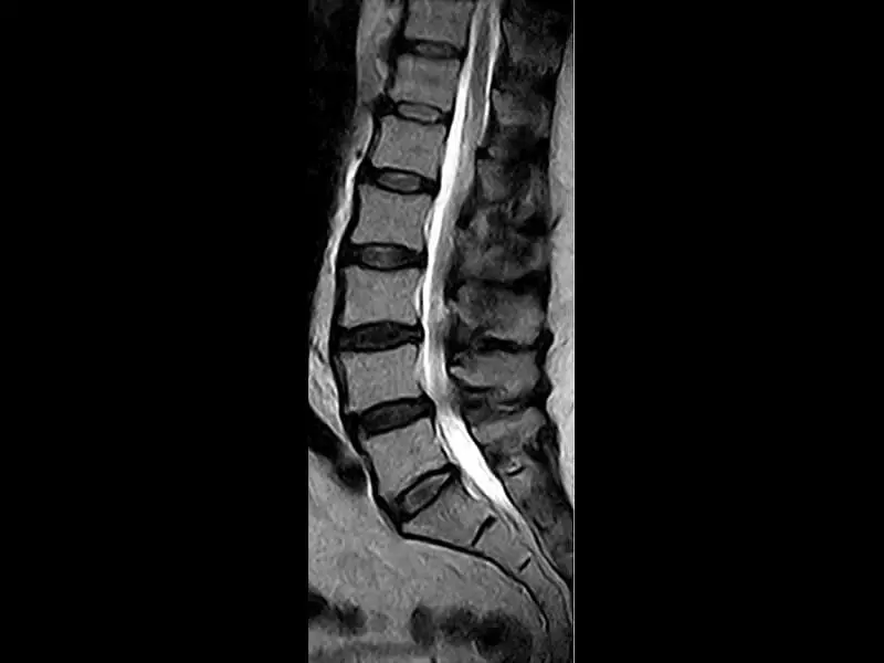 Magnifico™Open - Spine 1