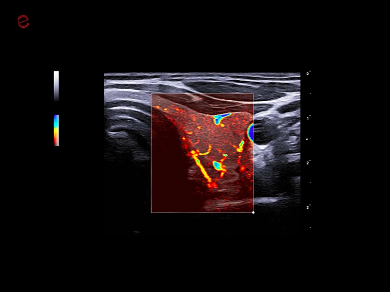 MyLab™C25 - MICRO-V-thyroid-linear