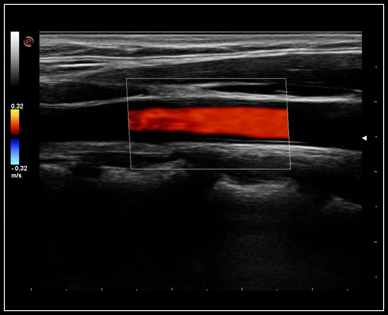 MyLab™Omega - Common Carotid Artery CFM