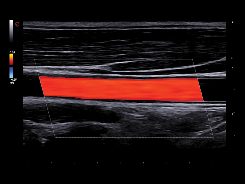 MyLab™A50 - vascular CFM
