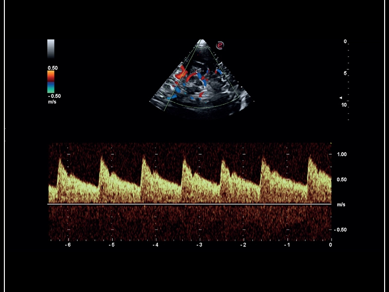 MyLab™Sigma - Mid cerebral artery investigation with PW Doppler mode