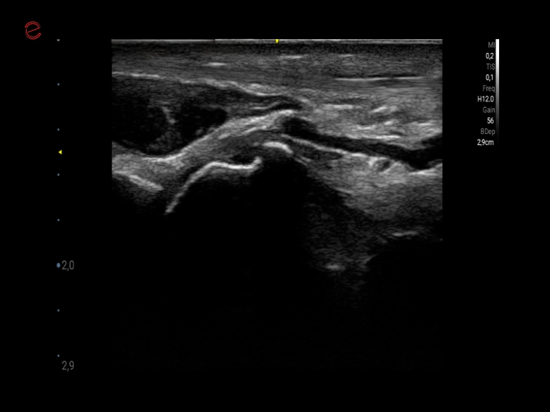 Q7 - GI Shoulder