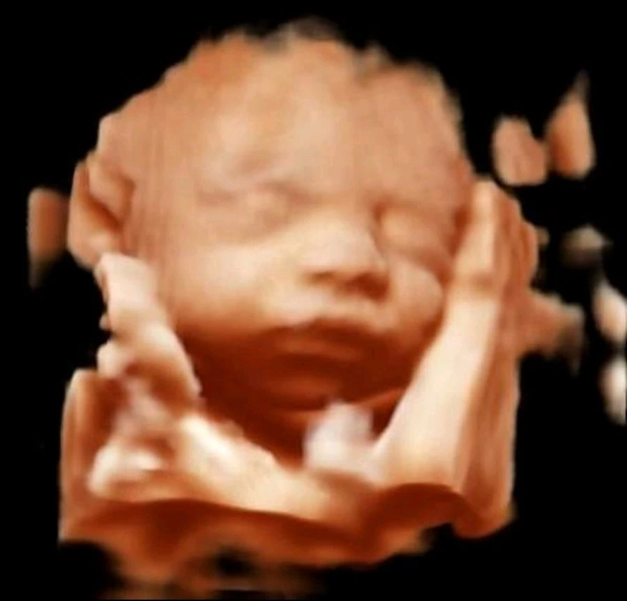 MyLab™Omega - BabyFace using XLight