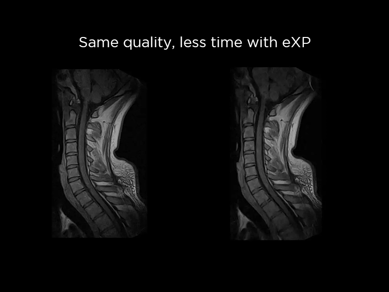 S-scan Open - eXP Cervical