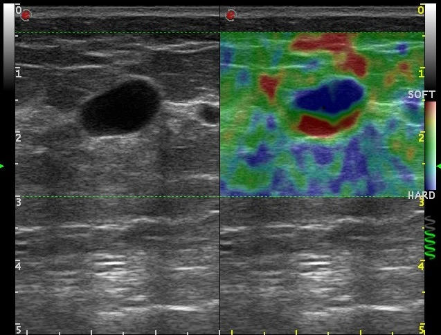 MyLab™Omega - Dual ElaXto on breast cyst