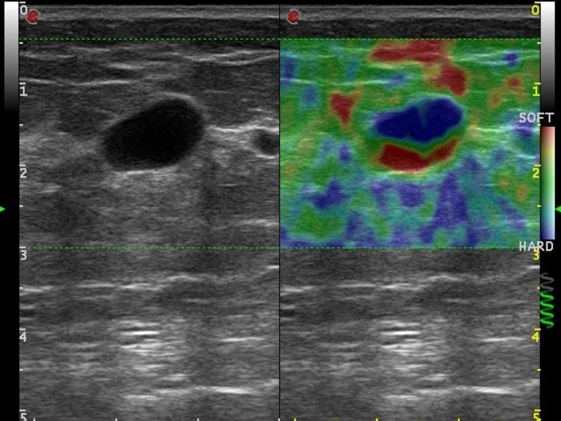 MyLab™Omega - Dual ElaXto on breast cyst