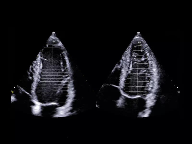 MyLab™X90 - AutoEF Automatic Ejection fraction assessment of the left ventricle