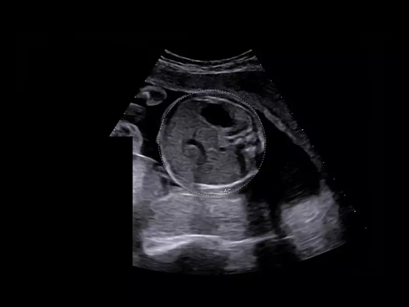 MyLab™X90 - Automatic Plan recognition Automatic biometric plan recognition for fetal measurements