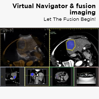 Virtual Navigator & fusion imaging: Let The Fusion Begin!