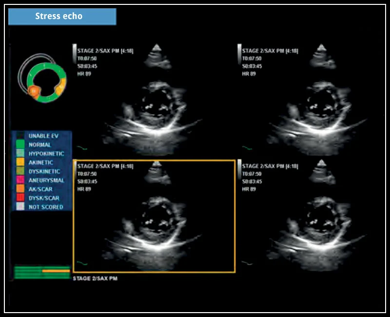 MyLab™X5 - Stress echo