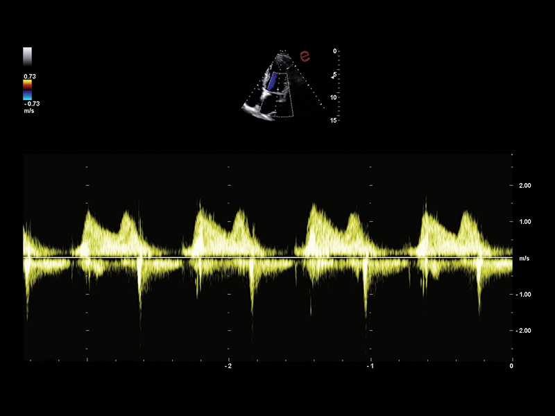 MyLab™A50 - Heart CW