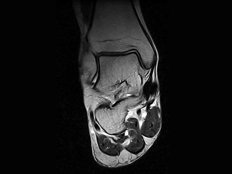 Magnifico™Open - Ankle FSE T2 Coronal