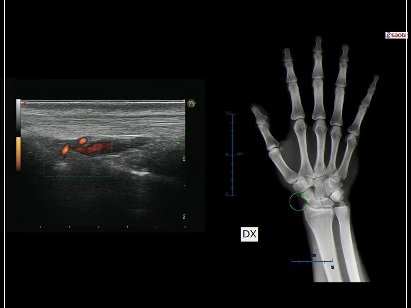 MyLab™9 Platform - MSK BodyMap and real-time XFlow on X-Ray extremities