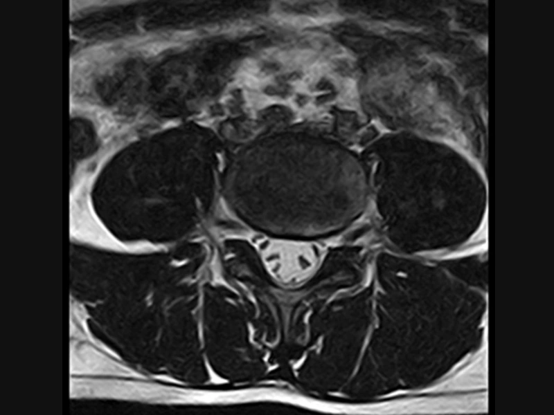 Magnifico™Open - Lspine 3D HYCE axial